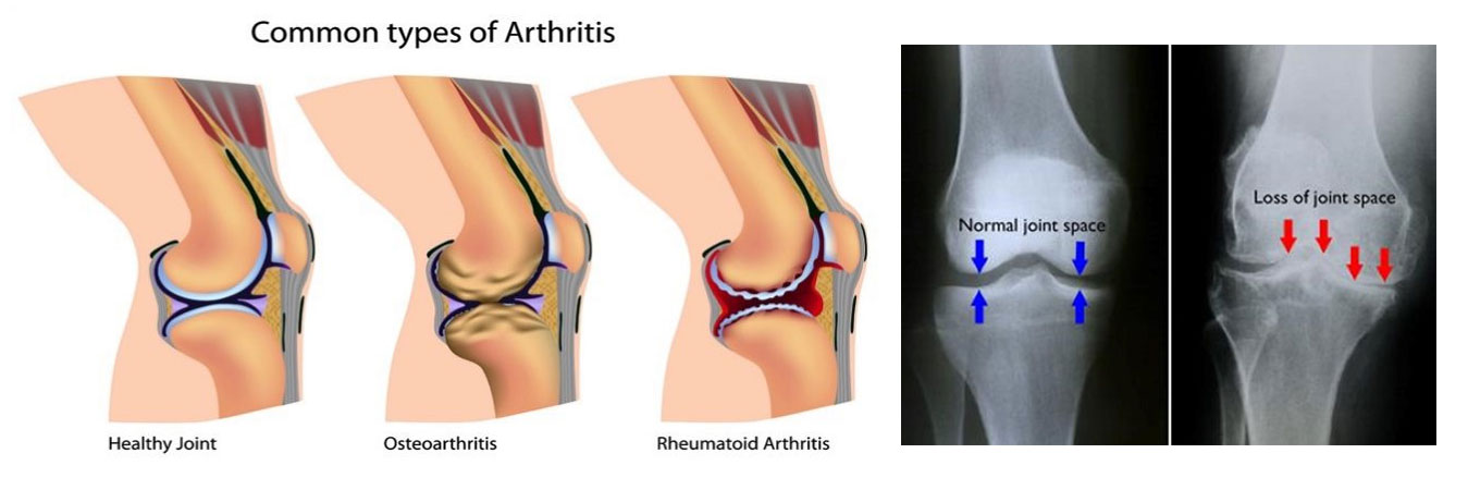 Arthritis Doctor In Jaipur