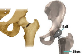 Knee Replacement Doctor In Jaipur