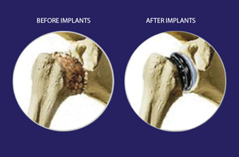 Knee Replacement Doctor In Jaipur